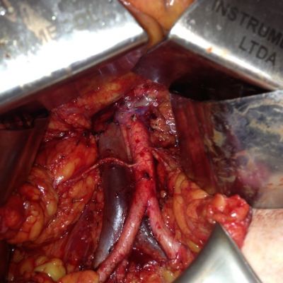 Polar Renal 2 Min