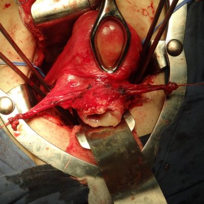 Traquelectomia Abdominal Min