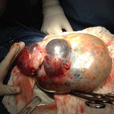 Tumor Ovarico Min