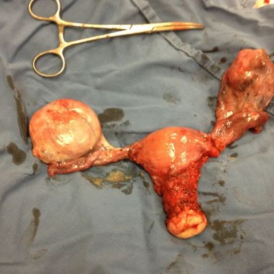 Tx Ovario Bilateral Min